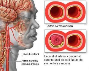 Accidentul Vascular Cerebral Cauze Simptome Preventie Si Tratare Hot