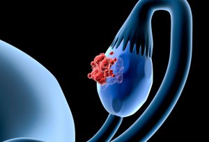 cancer-ovarian1