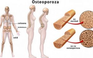 osteoporoza