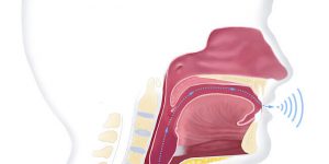 Clarfon laringectomie