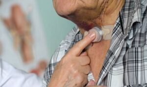 Porți o canulă traheală ,Foloseşte filtrele HME de la Clarfon pentru sănătatea plămânilor tăi