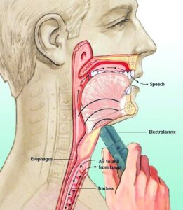 Laringectomie Clarfon (1)