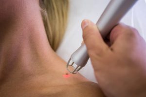 dermatologist-removing-mole-from-womans-shoulder