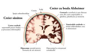 boala-alzheimer-simptome-debut-evolutie-si-tratament-anatomie