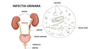 _INFECTIA_URINARA