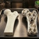 Cum arată osteoporoza și cum se poate preveni – Doctor Sorică Stelian